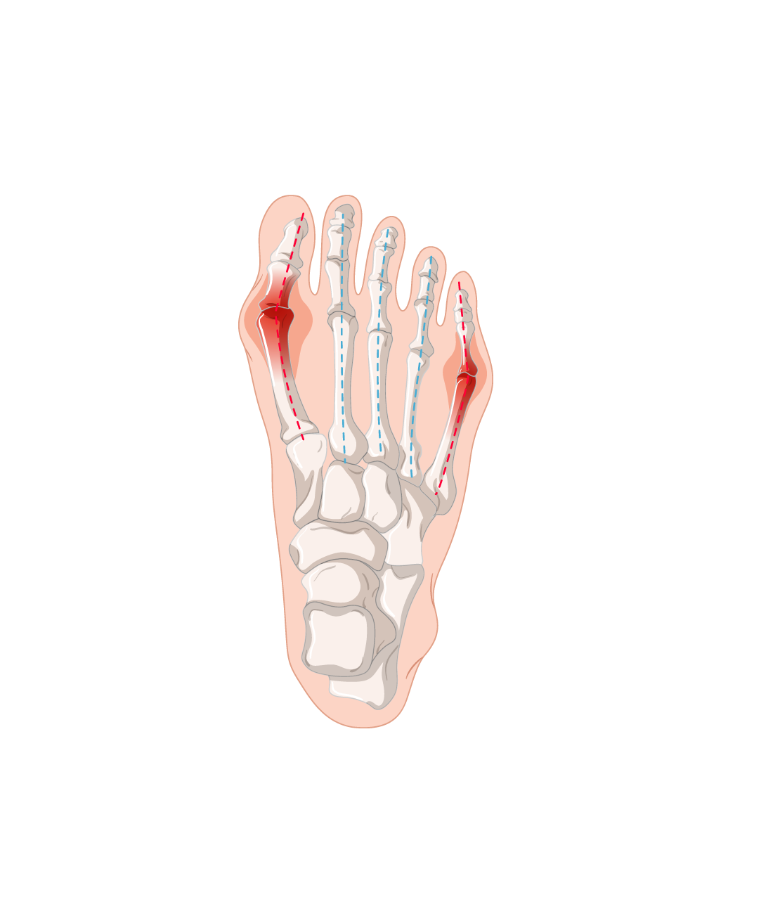 Joanete (Hálux Valgo)